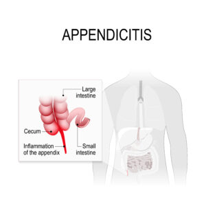 Appendectomy Cape Town | Appendix Removal Surgery